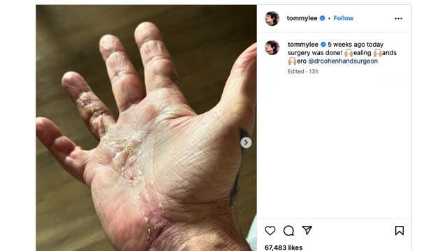 Motley Crue's Tommy Lee Updates On Fans On Surgery Recovery